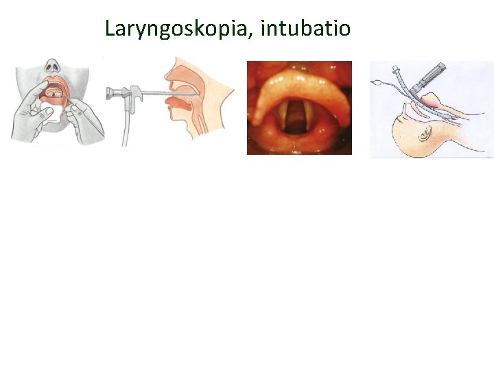 Laryngoskopia, intubatio Laryngoskopia, intubatio