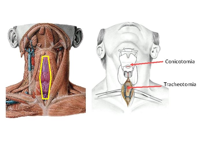 Conicotomia Tracheotomia Conicotomia Tracheotomia