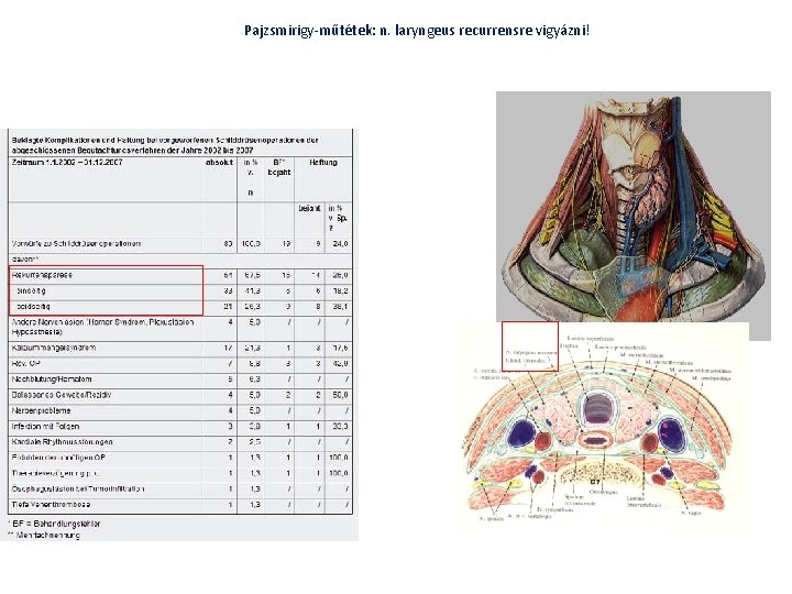Pajzsmirigy-műtétek: n. laryngeus recurrensre vigyázni! Pajzsmirigy-műtétek: n. laryngeus recurrensre vigyázni!