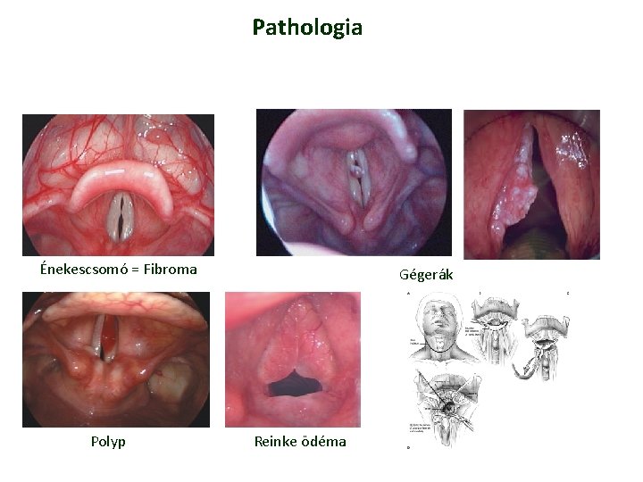 Pathologia Énekescsomó = Fibroma Polyp Gégerák Reinke ödéma Pathologia Énekescsomó = Fibroma Polyp Gégerák Reinke ödéma