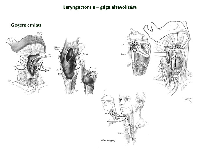 Laryngectomia – gége eltávolítása Gégerák miatt Laryngectomia – gége eltávolítása Gégerák miatt