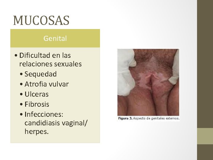 MUCOSAS Genital • Dificultad en las relaciones sexuales • Sequedad • Atrofia vulvar •