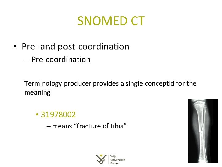SNOMED CT • Pre- and post-coordination – Pre-coordination Terminology producer provides a single conceptid SNOMED CT • Pre- and post-coordination – Pre-coordination Terminology producer provides a single conceptid