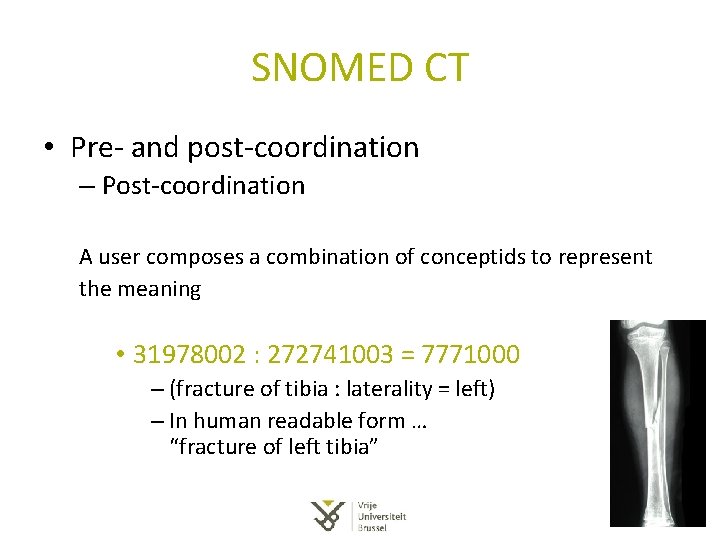 SNOMED CT • Pre- and post-coordination – Post-coordination A user composes a combination of SNOMED CT • Pre- and post-coordination – Post-coordination A user composes a combination of