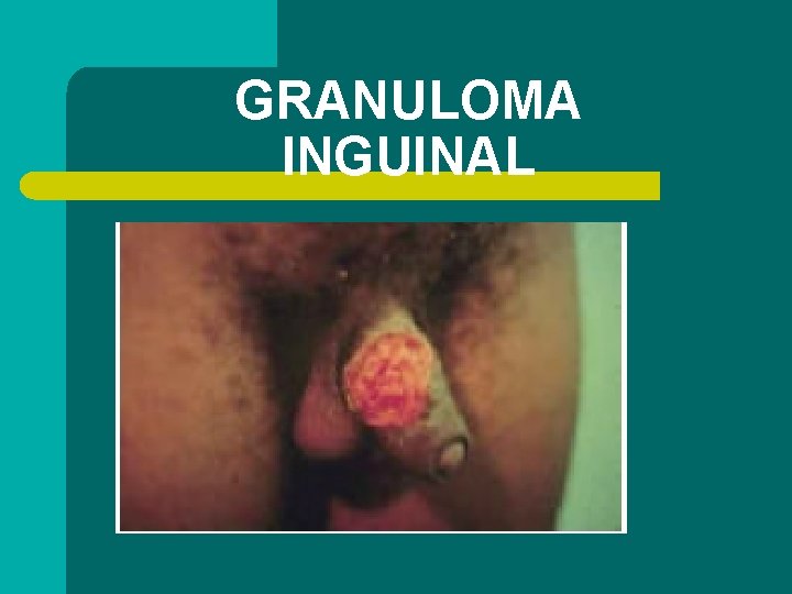 GRANULOMA INGUINAL 