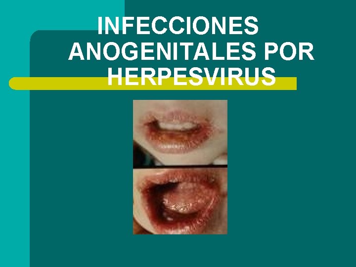 INFECCIONES ANOGENITALES POR HERPESVIRUS 