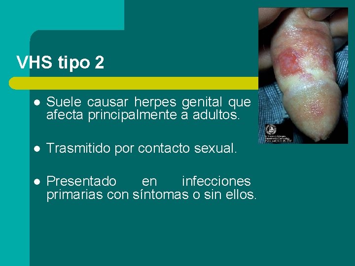 VHS tipo 2 l Suele causar herpes genital que afecta principalmente a adultos. l