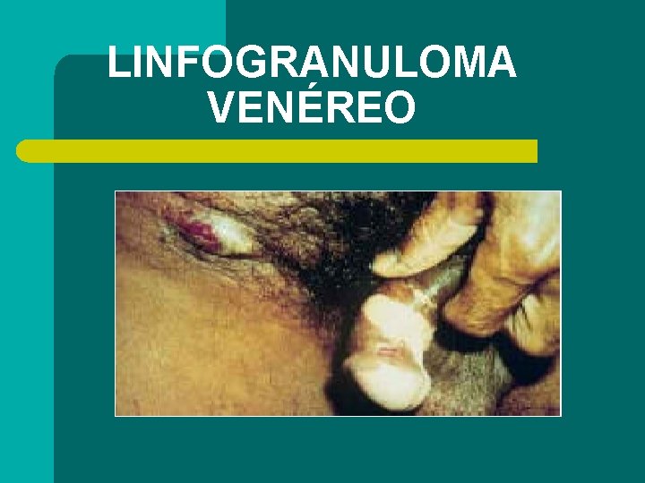 LINFOGRANULOMA VENÉREO 