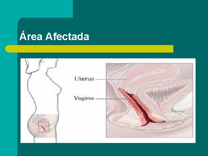 Área Afectada 