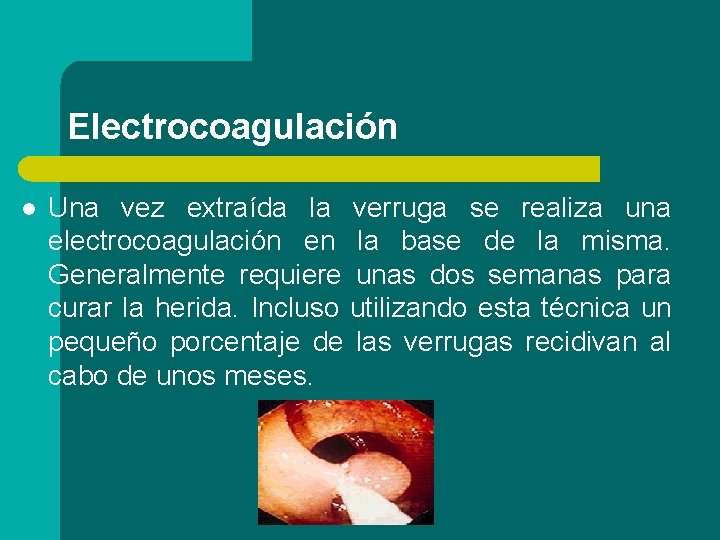 Electrocoagulación l Una vez extraída la verruga se realiza una electrocoagulación en la base