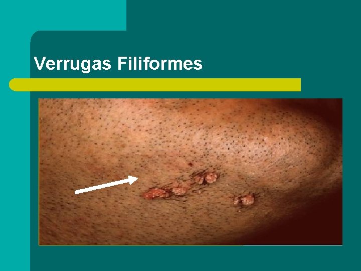 Verrugas Filiformes 