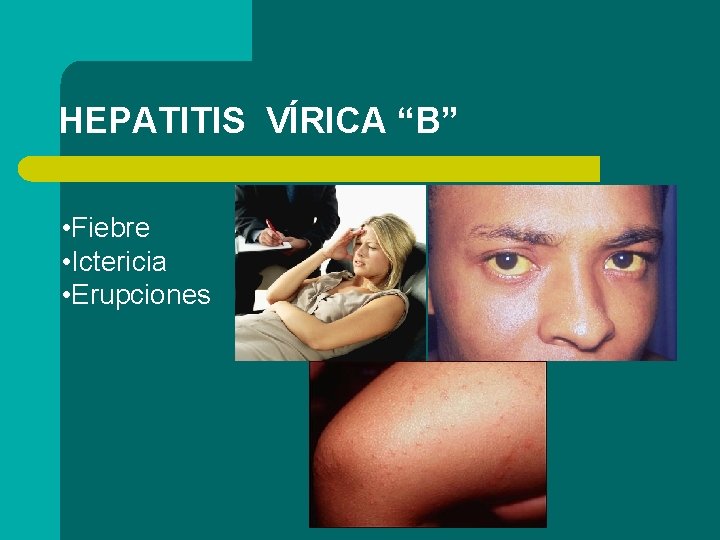 HEPATITIS VÍRICA “B” • Fiebre • Ictericia • Erupciones 