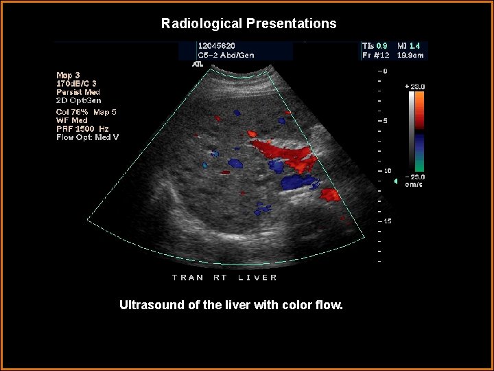 Radiological Presentations Ultrasound of the liver with color flow. 