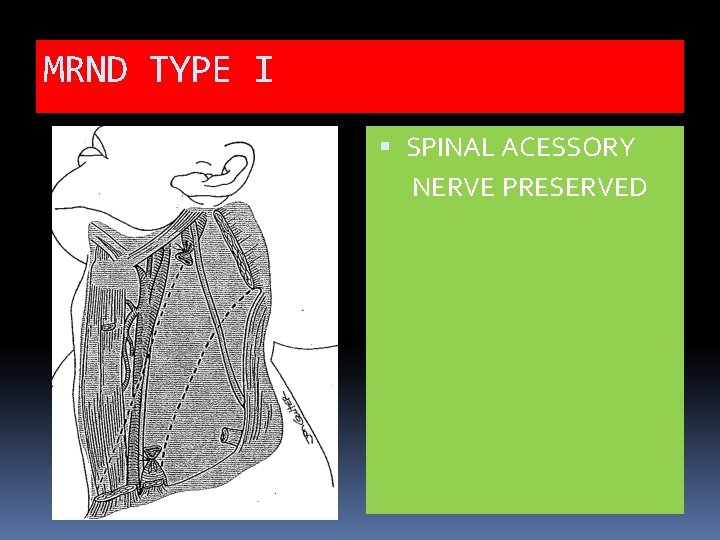 MRND TYPE I SPINAL ACESSORY NERVE PRESERVED 