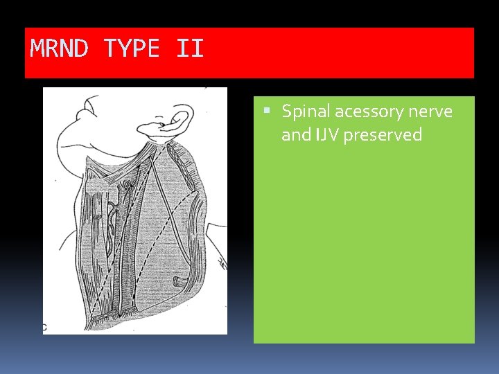 MRND TYPE II Spinal acessory nerve and IJV preserved 