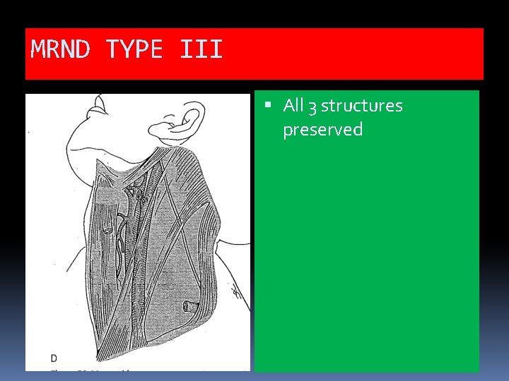 MRND TYPE III All 3 structures preserved 