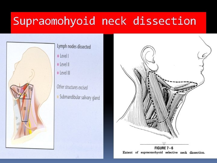 Supraomohyoid neck dissection 