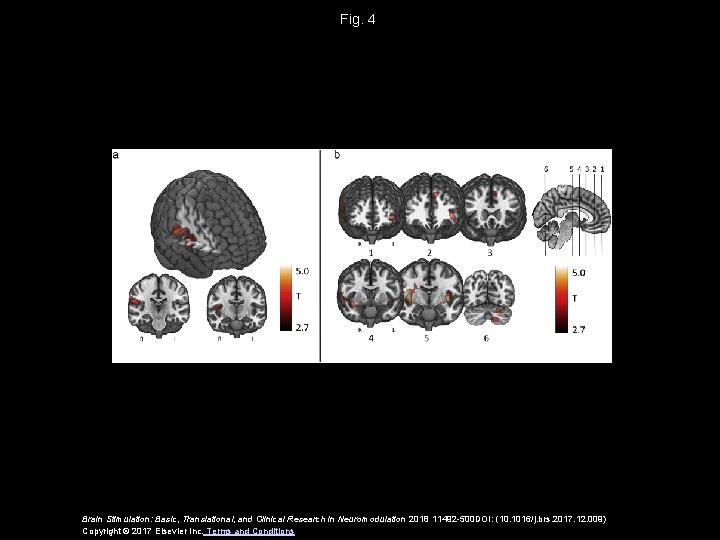 Fig. 4 Brain Stimulation: Basic, Translational, and Clinical Research in Neuromodulation 2018 11492 -500