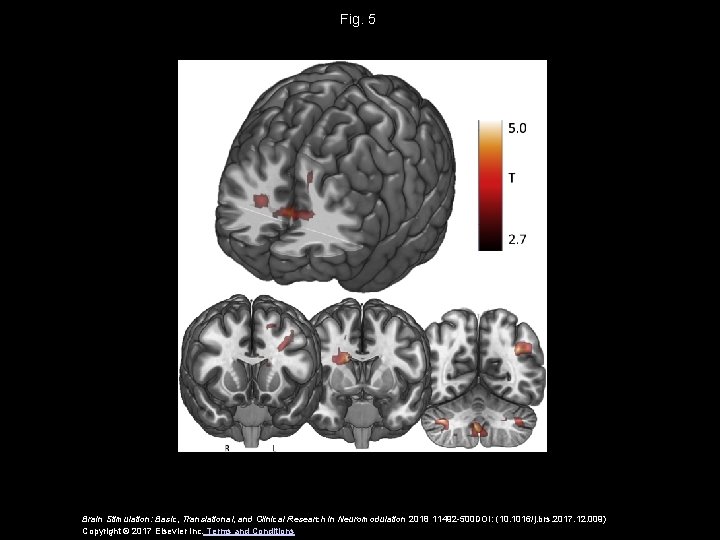 Fig. 5 Brain Stimulation: Basic, Translational, and Clinical Research in Neuromodulation 2018 11492 -500