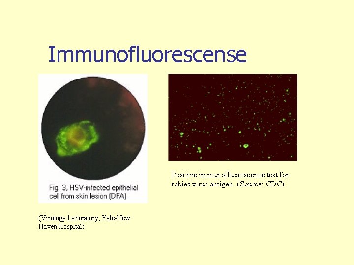 Immunofluorescense Positive immunofluorescence test for rabies virus antigen. (Source: CDC) (Virology Laboratory, Yale-New Haven