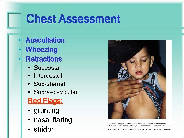 Chest Assessment Chest • Auscultation • Wheezing • Retractions • • Subcostal Intercostal Sub-sternal