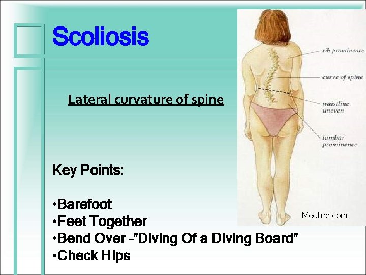 Scoliosis Lateral curvature of spine Key Points: • Barefoot • Feet Together • Bend