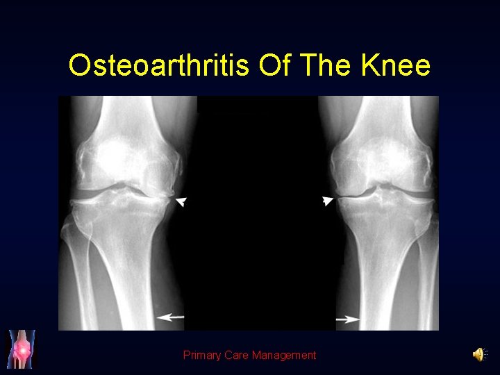 Osteoarthritis Of The Knee Primary Care Management 