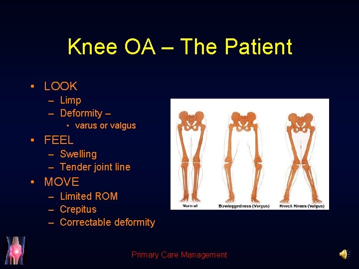 Knee OA – The Patient • LOOK – Limp – Deformity – • varus