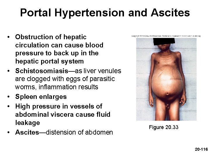 Portal Hypertension and Ascites • Obstruction of hepatic circulation cause blood pressure to back