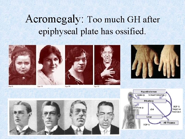 Acromegaly: Too much GH after epiphyseal plate has ossified. Acromegaly: Too much GH after epiphyseal plate has ossified.