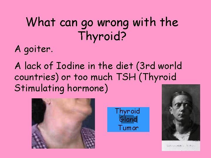 What can go wrong with the Thyroid? A goiter. A lack of Iodine in What can go wrong with the Thyroid? A goiter. A lack of Iodine in