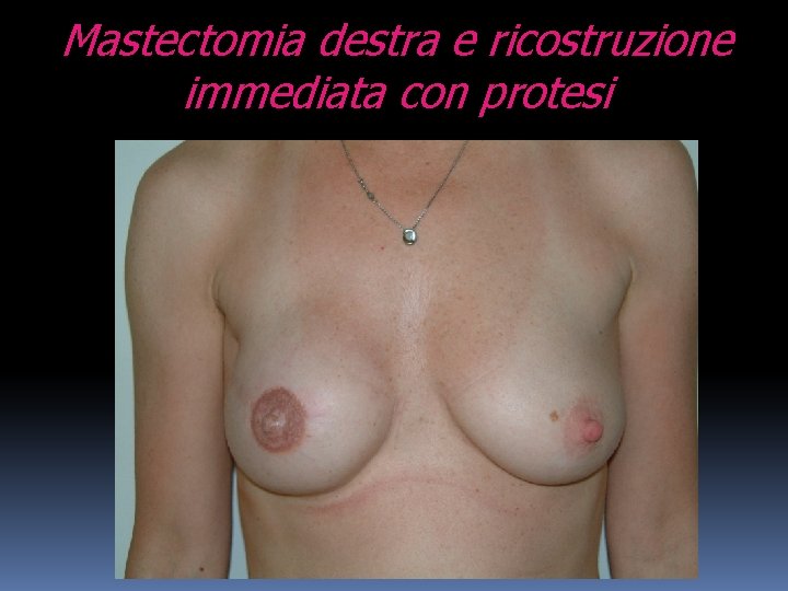 Mastectomia destra e ricostruzione immediata con protesi 