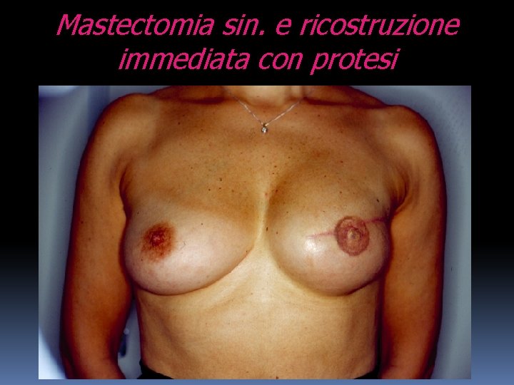 Mastectomia sin. e ricostruzione immediata con protesi 