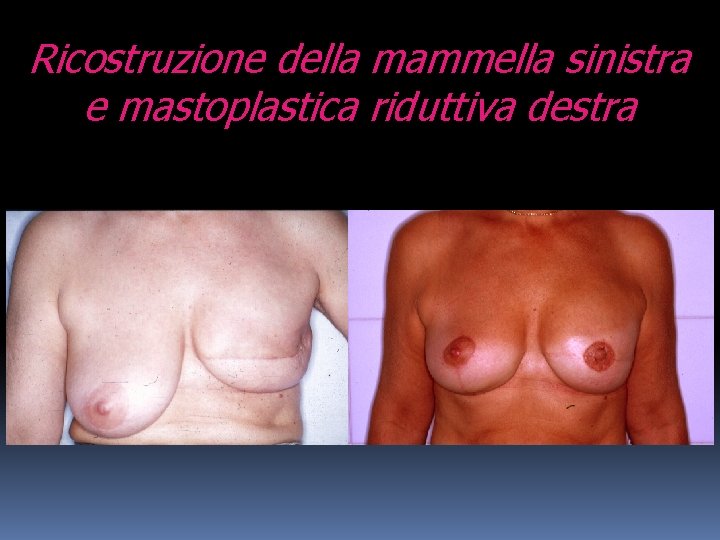 Ricostruzione della mammella sinistra e mastoplastica riduttiva destra 