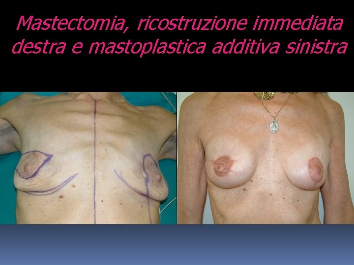 Mastectomia, ricostruzione immediata destra e mastoplastica additiva sinistra 