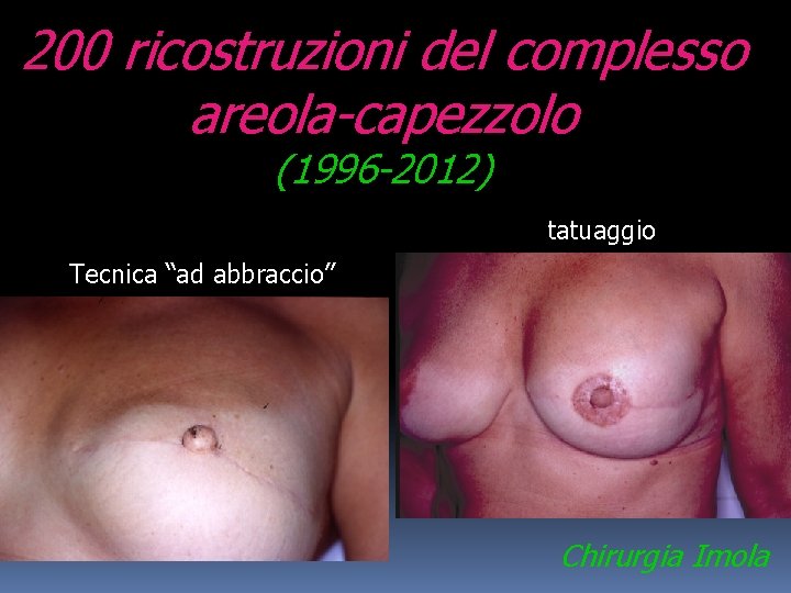 200 ricostruzioni del complesso areola-capezzolo (1996 -2012) tatuaggio Tecnica “ad abbraccio” Chirurgia Imola 