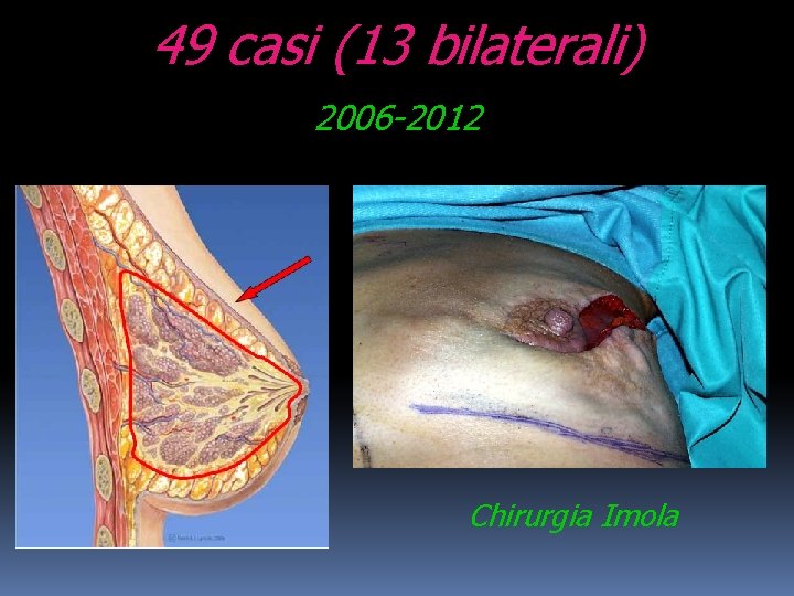 49 casi (13 bilaterali) 2006 -2012 Chirurgia Imola 