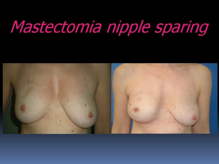 Mastectomia nipple sparing 