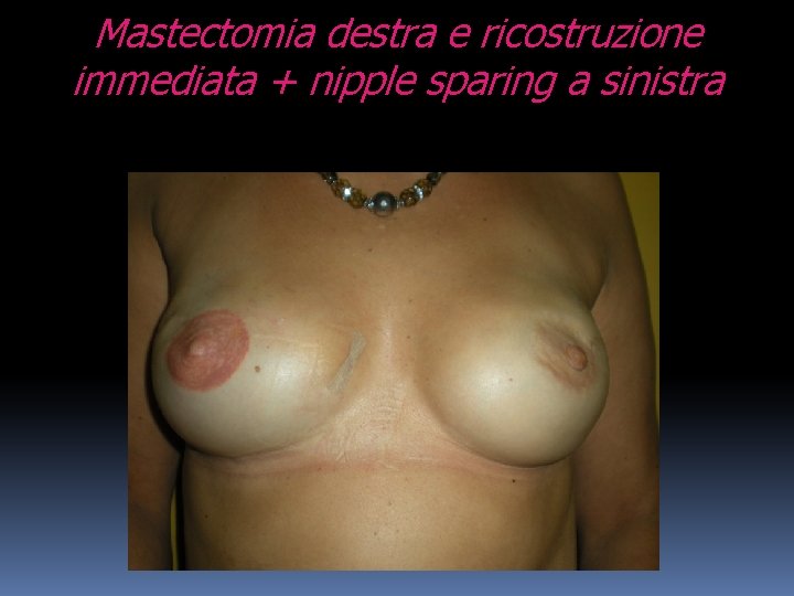 Mastectomia destra e ricostruzione immediata + nipple sparing a sinistra 