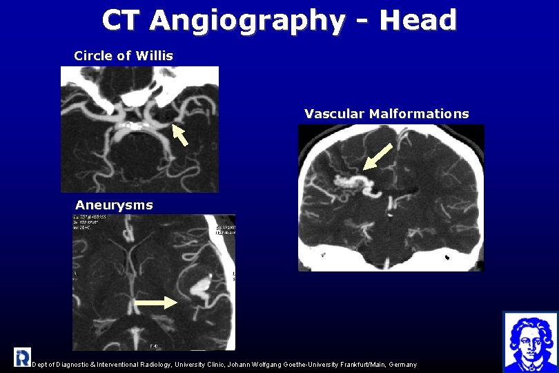 CT Angiography - Head Circle of Willis Vascular Malformations Aneurysms Dept of Diagnostic &