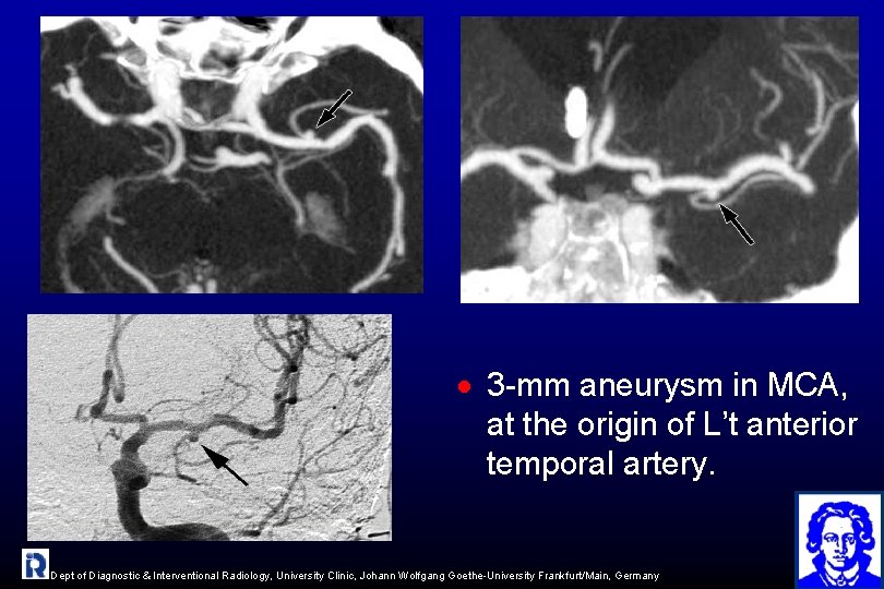 · 3 -mm aneurysm in MCA, at the origin of L’t anterior temporal artery.