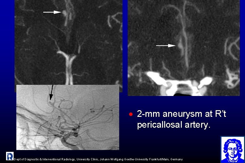 · 2 -mm aneurysm at R’t pericallosal artery. Dept of Diagnostic & Interventional Radiology,