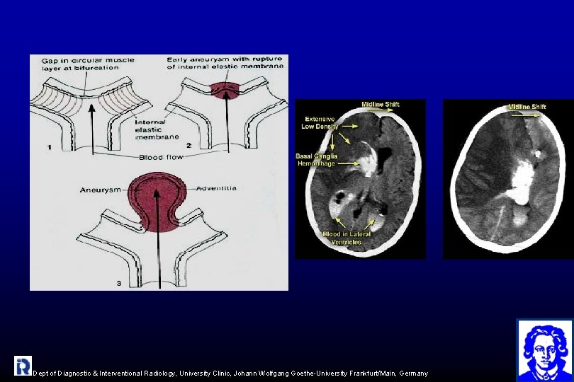 Dept of Diagnostic & Interventional Radiology, University Clinic, Johann Wolfgang Goethe-University Frankfurt/Main, Germany 