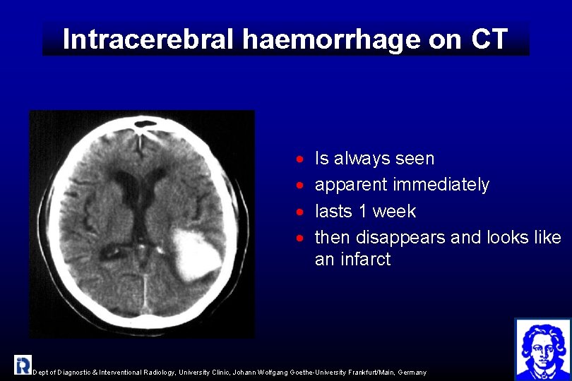 Intracerebral haemorrhage on CT · · Is always seen apparent immediately lasts 1 week