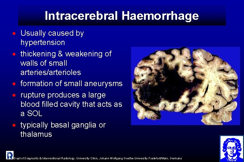 Intracerebral Haemorrhage · Usually caused by hypertension · thickening & weakening of walls of