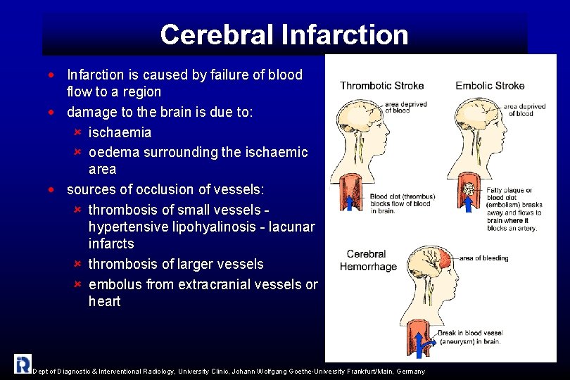 Cerebral Infarction · Infarction is caused by failure of blood flow to a region
