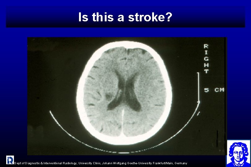 Is this a stroke? Dept of Diagnostic & Interventional Radiology, University Clinic, Johann Wolfgang