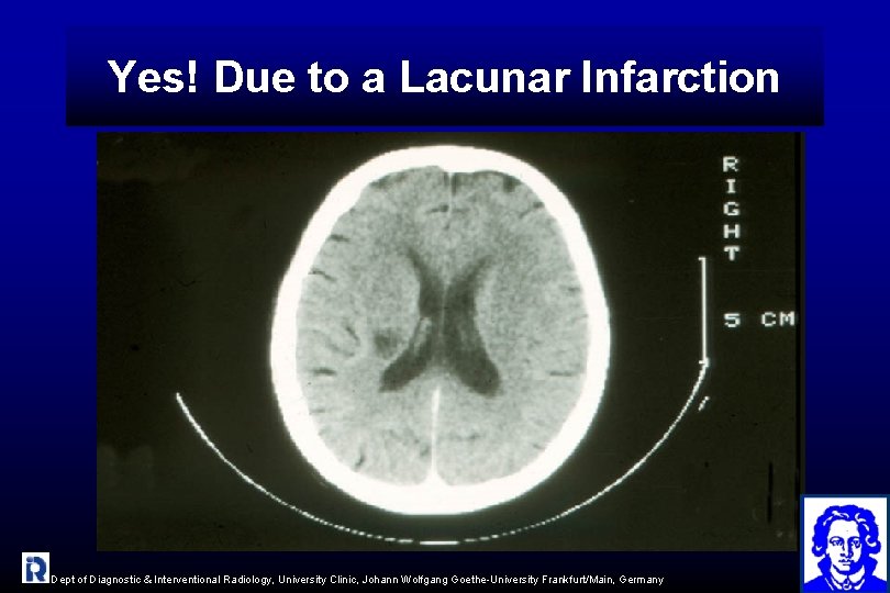 Yes! Due to a Lacunar Infarction Dept of Diagnostic & Interventional Radiology, University Clinic,