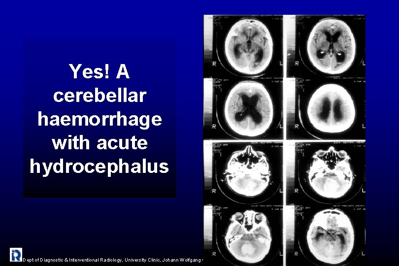 Yes! A cerebellar haemorrhage with acute hydrocephalus Dept of Diagnostic & Interventional Radiology, University