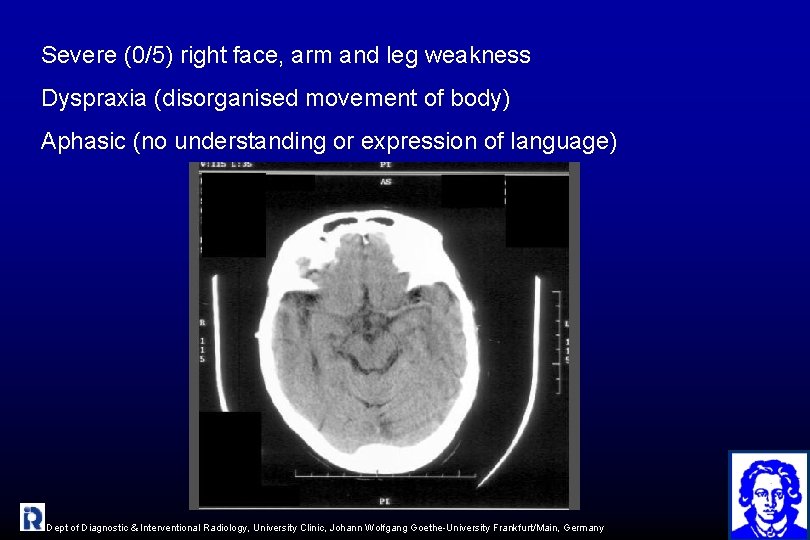 Severe (0/5) right face, arm and leg weakness Dyspraxia (disorganised movement of body) Aphasic